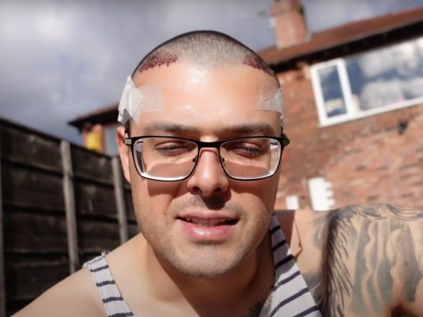 Lewis-Ellis-Hair-Transplant-Pic-4